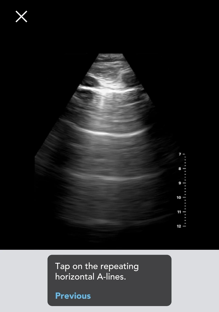 Actual A-line reference image from the app’s Lung Pathology module, with its original identification prompt.